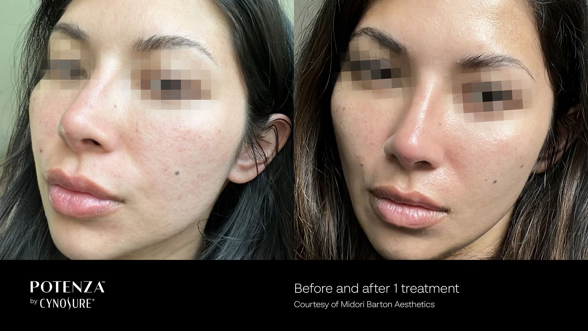 Before-and-after comparison of a person's facial skin texture, showing improvements following a Potenza skin treatment.