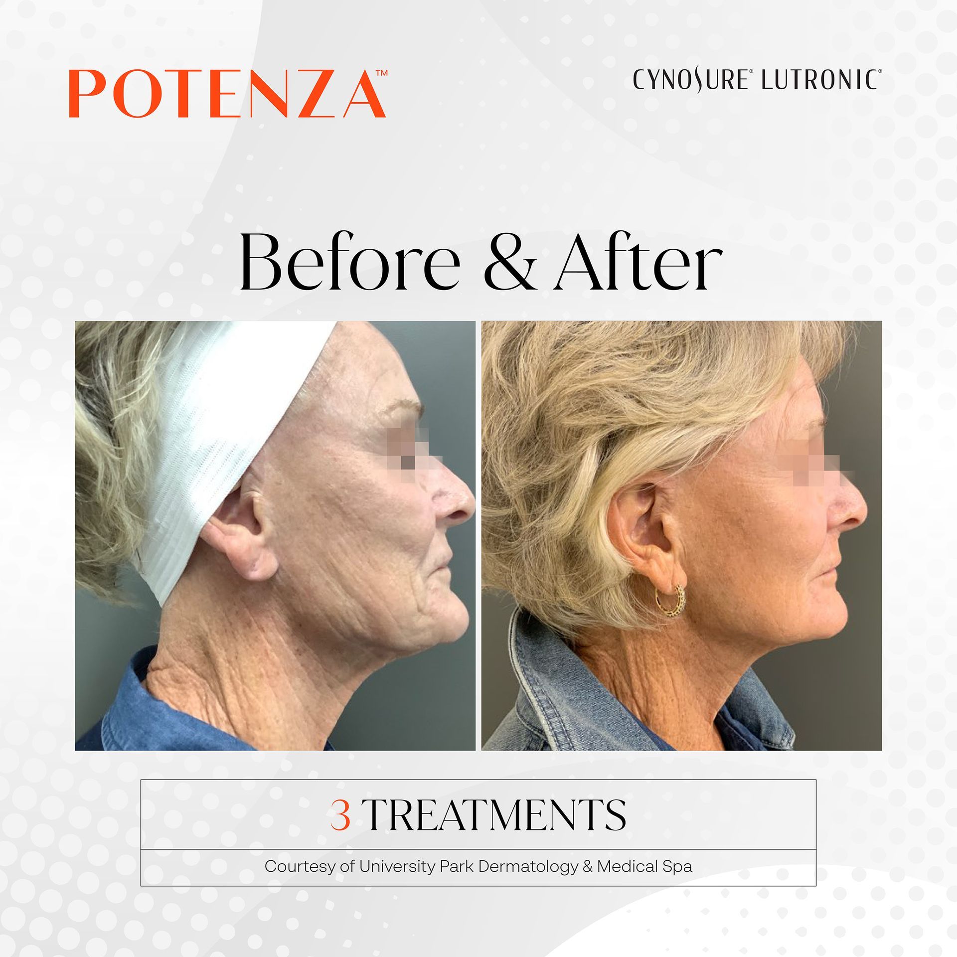 Before and after comparison of a patient's side profile showing skin tightening results after 3 Potenza treatments.