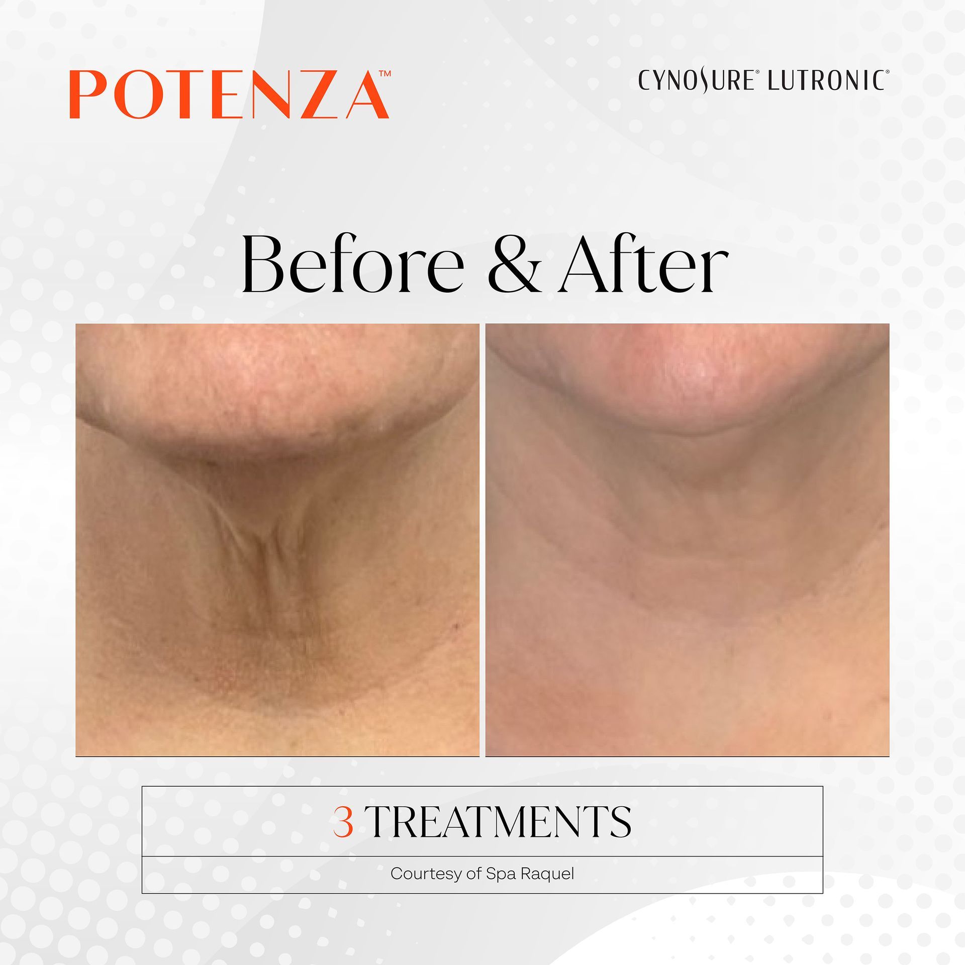 Before and after comparison of a person's neck after three Potenza cosmetic treatments, showing reduced skin laxity.