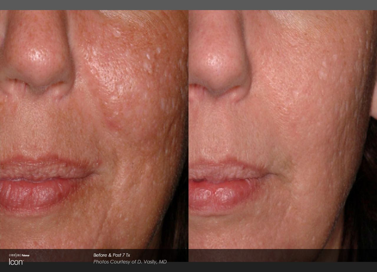 Before and after view of a face, showing a reduction in skin texture and bumps after a cosmetic procedure.
