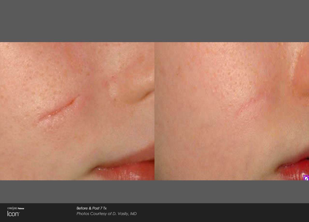 Before and after comparison showing a facial scar reduced in appearance after treatment.