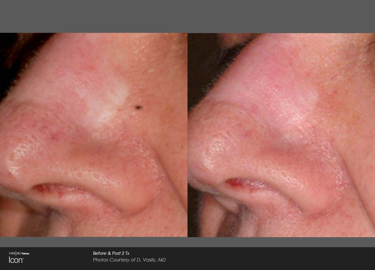 Before and after view of a skin area on the side of a nose, showing a reduction in a patch of light-colored skin.