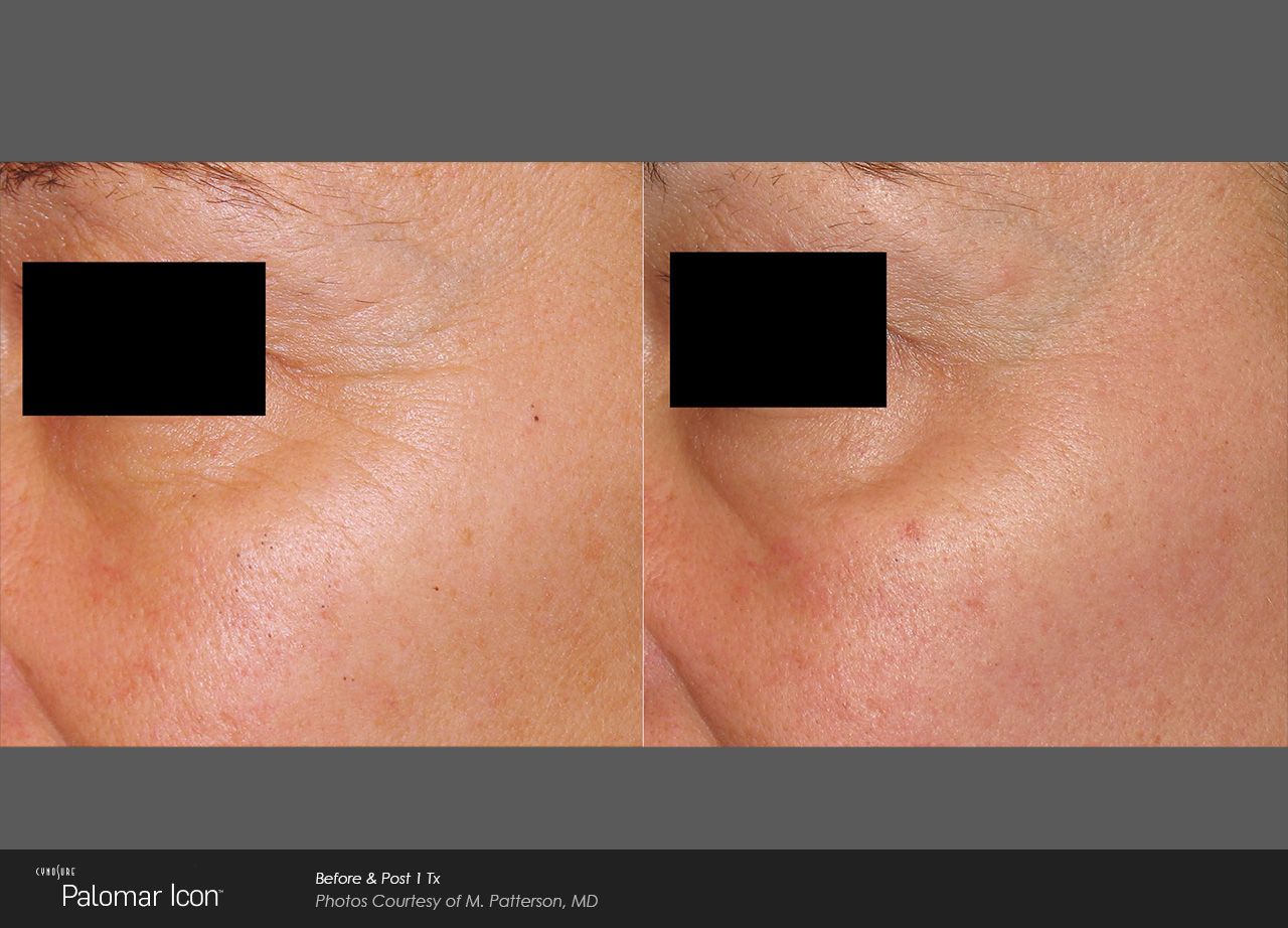 Before and after comparison of a person's under-eye area showing reduction in darkness and puffiness.