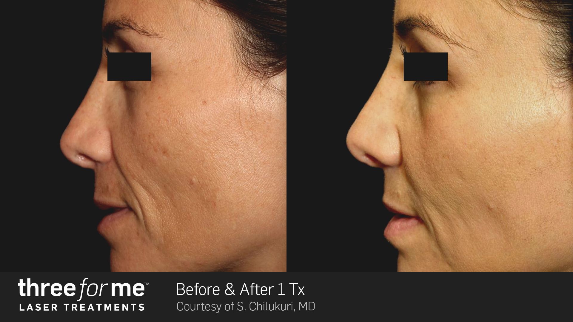 Before and after photos of a person's profile showing reduced facial wrinkles after one laser treatment.