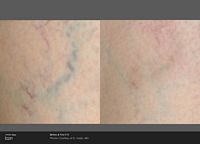 Side-by-side close-up skin photos showing a faint blue vein before and after treatment