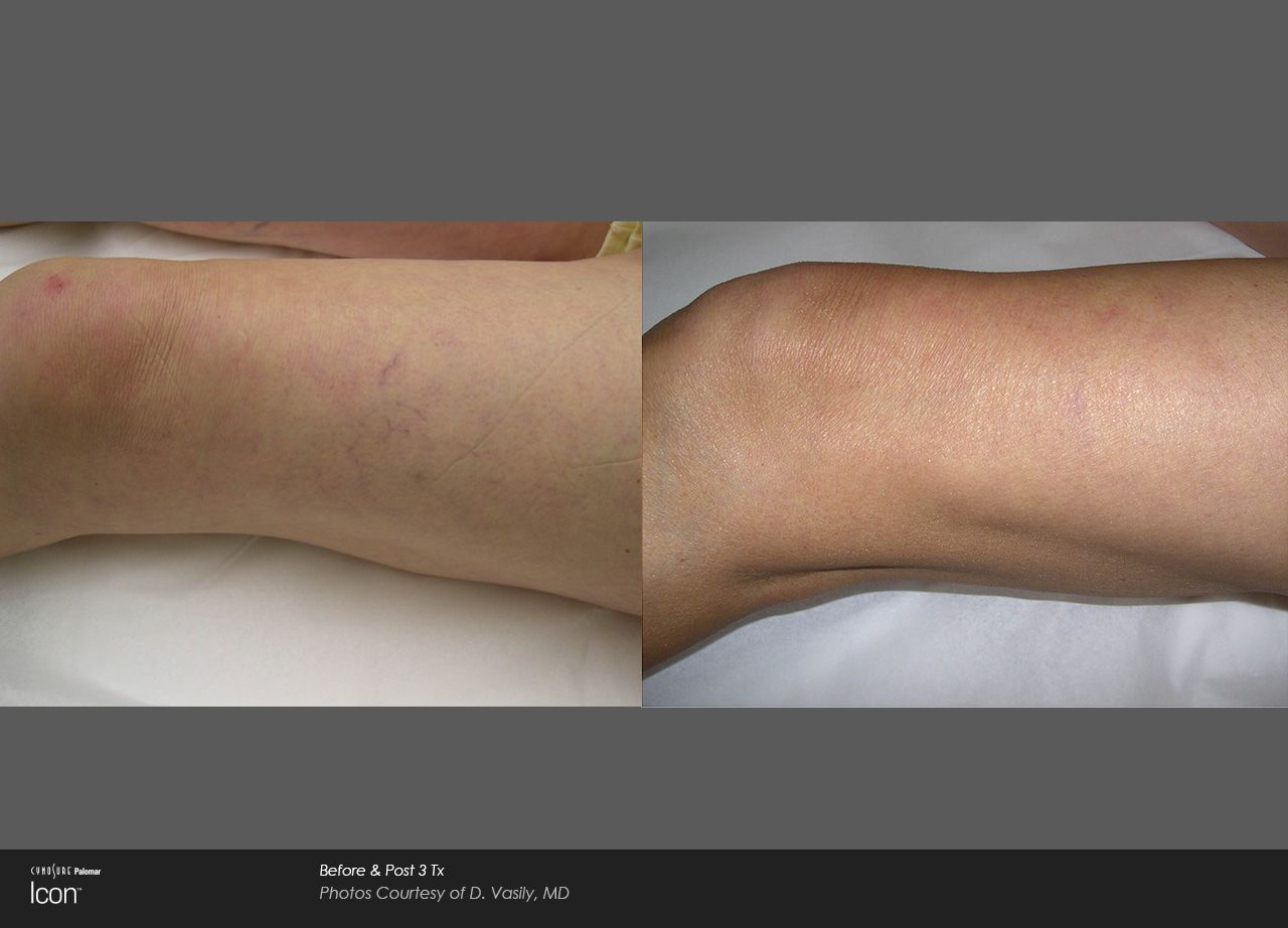 Split-screen close-up of a leg before and after treatment, showing bruising on the left and smoother skin on the right