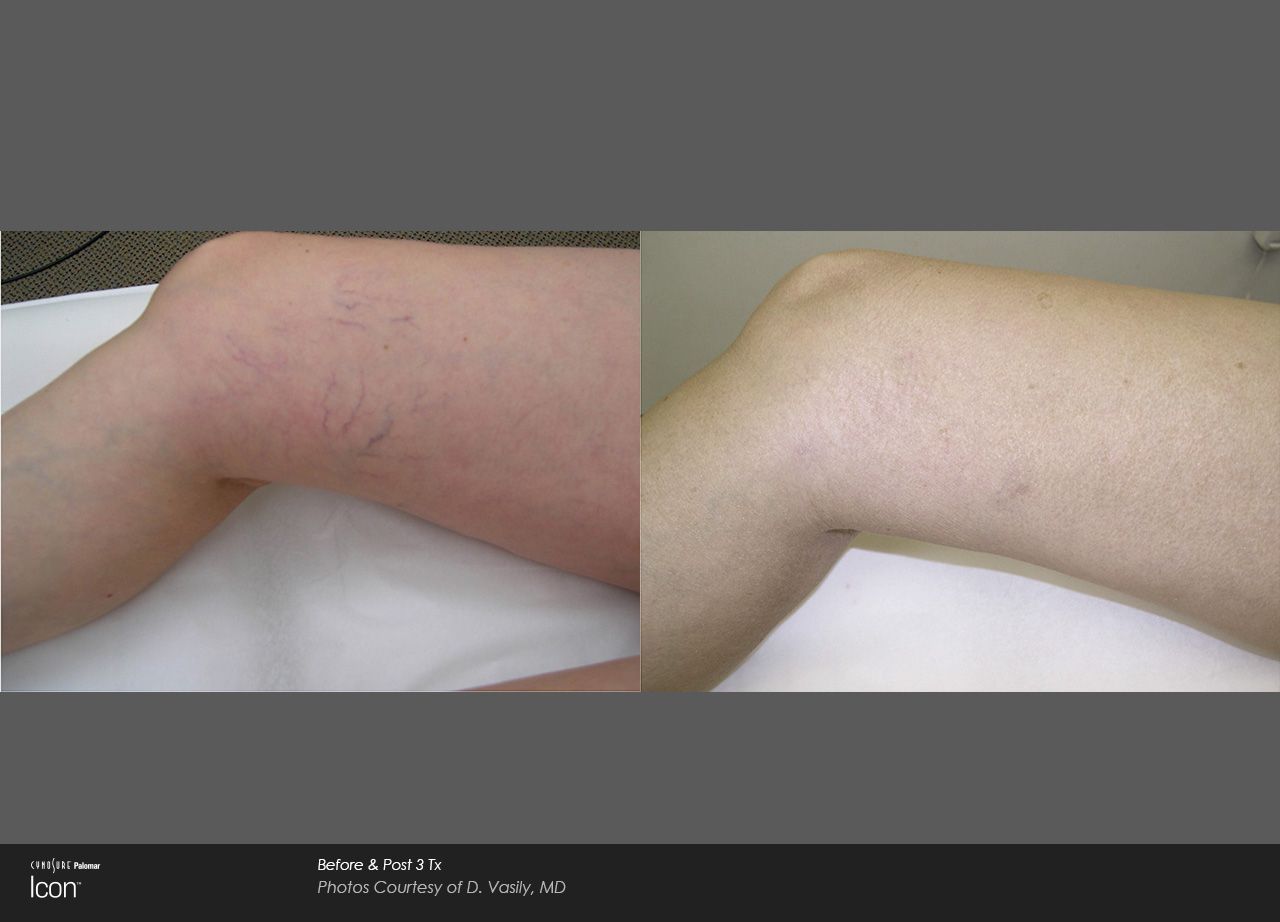 Side-by-side photos of a bent lower leg, showing a darker then lighter skin tone treatment area.