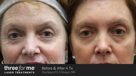 Side-by-side face photos showing skin improvement after treatment; left appears more wrinkled than right.