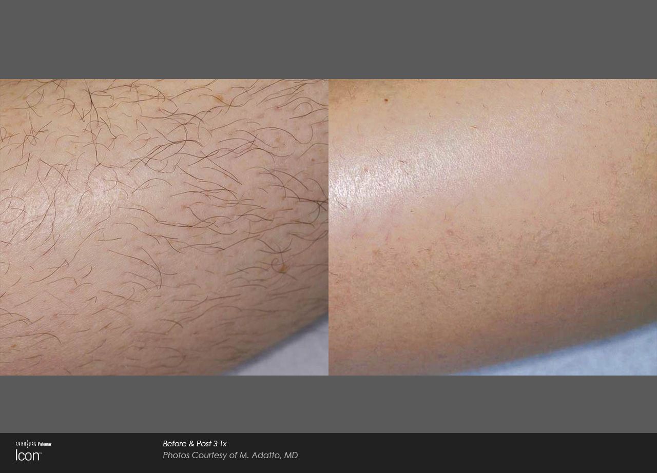 Close-up of a person’s leg with visible body hair and dry, textured skin.