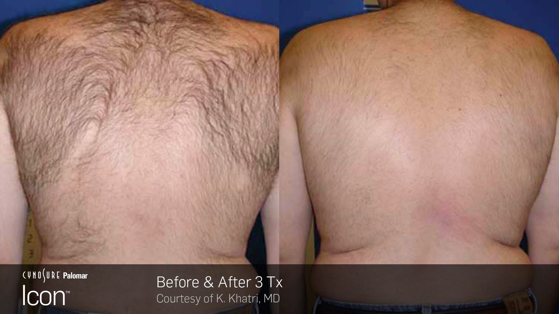 Side-by-side back view of a person before and after hair removal, showing less back hair on the right