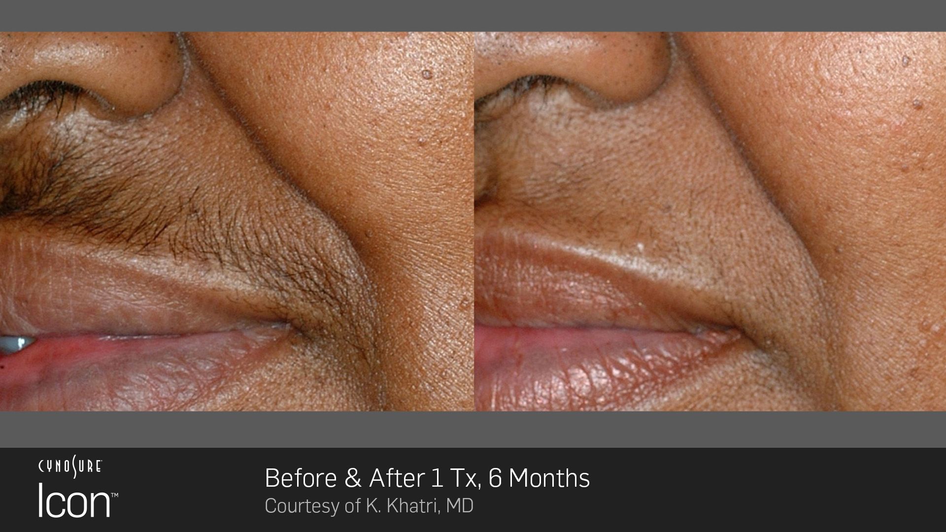 Close-up of facial skin before and after 3 months, showing reduced wrinkles and smoother lips