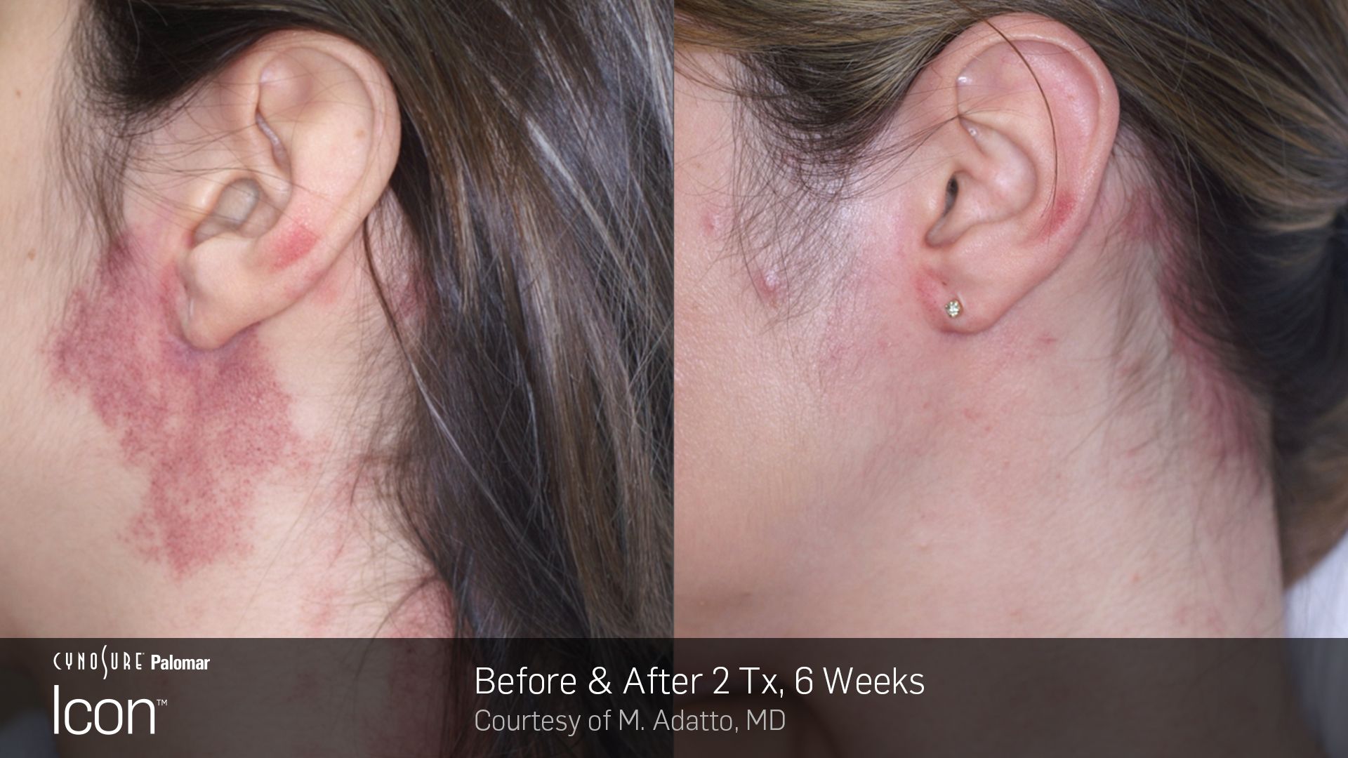Side-by-side facial profile showing a red-purple facial rash before and after treatment