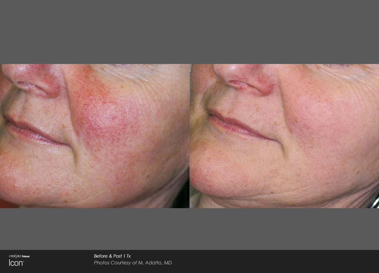 Side-by-side facial close-up showing a red rash on the left cheek compared with clear skin on the right.