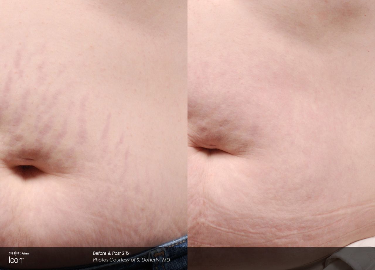 Close-up of a bare abdomen with belly button and skin folds against a neutral background