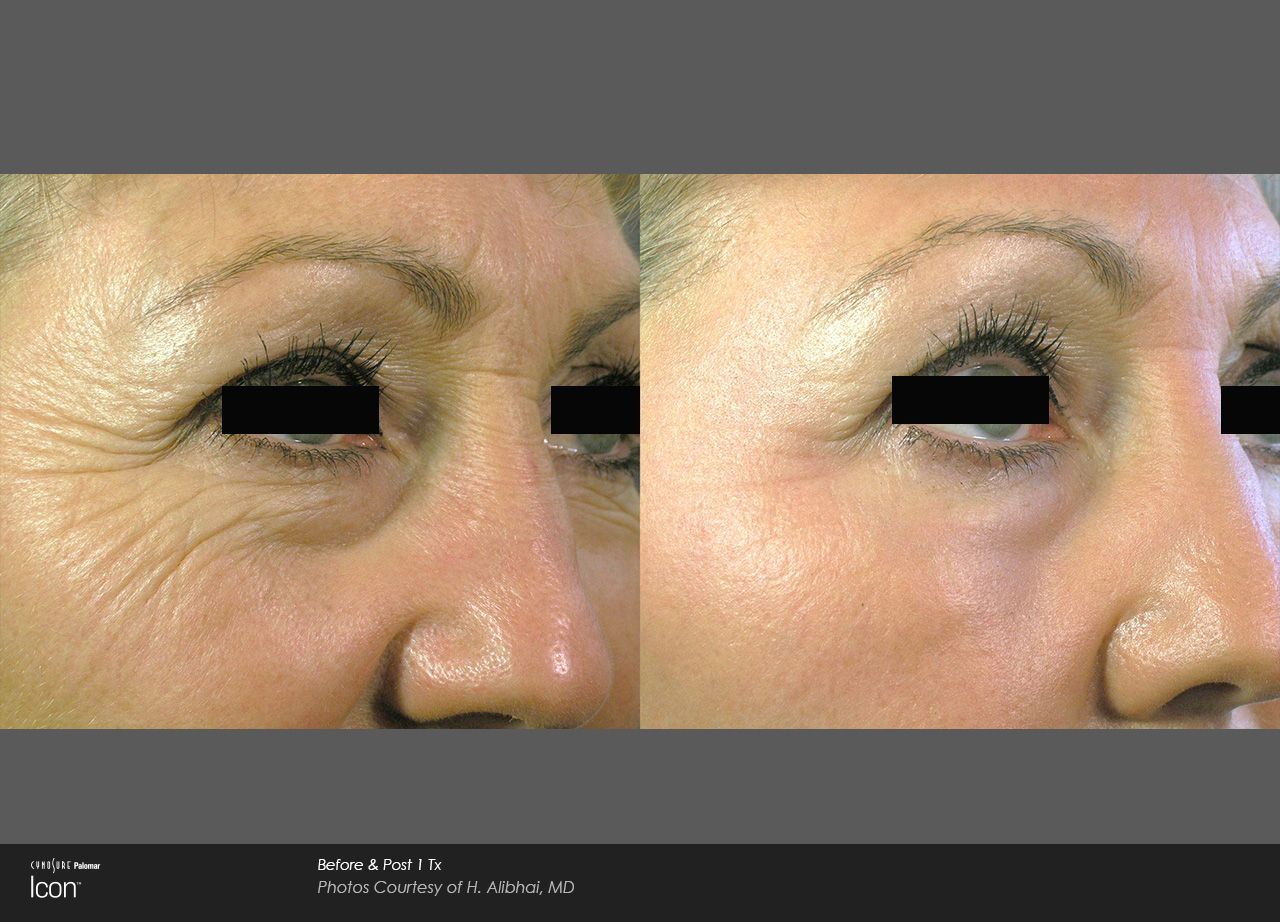 Close-up comparison of an eye area before and after treatment, showing reduced under-eye wrinkles and puffiness