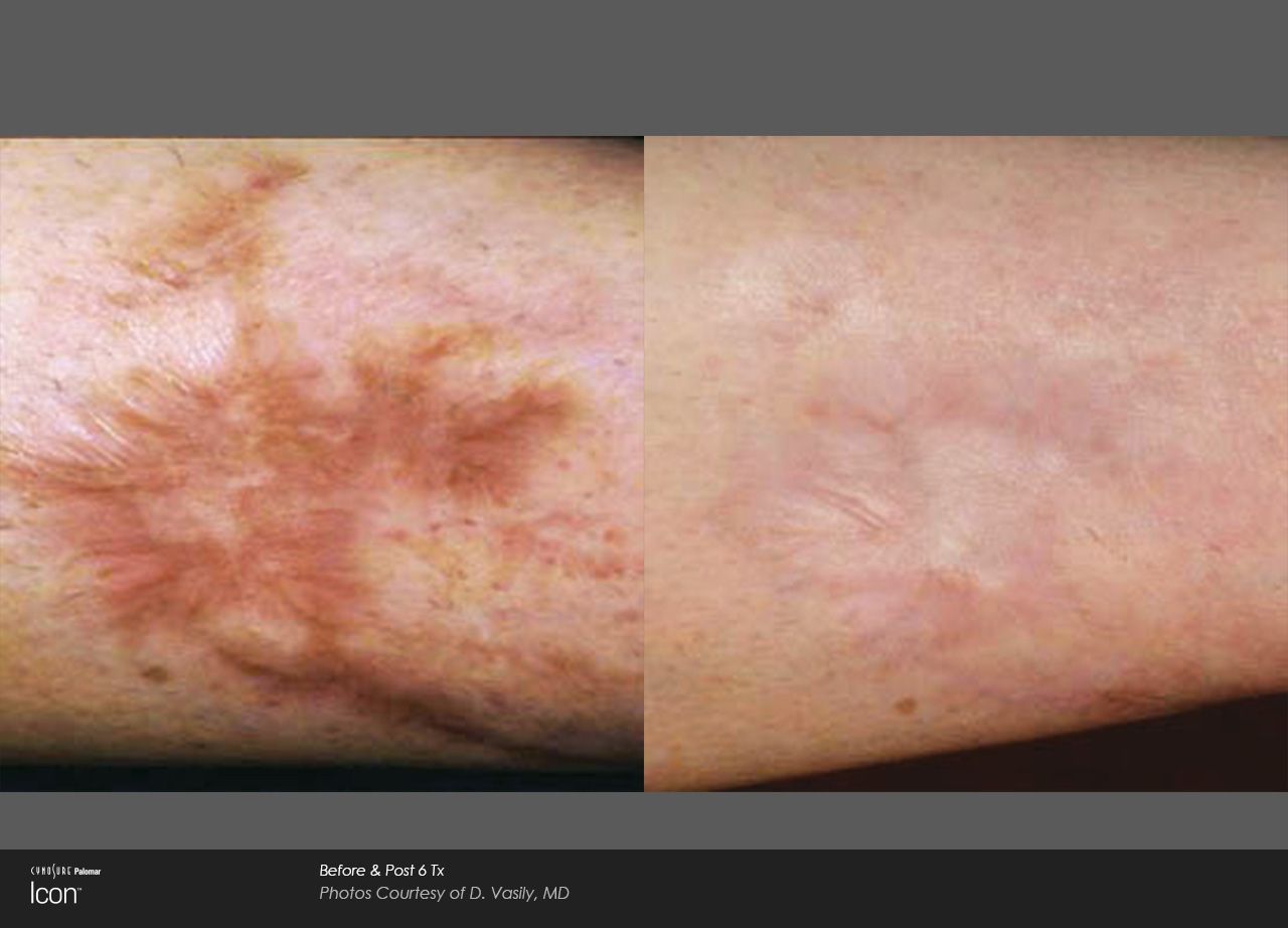 Close-up of a light skin patch with irregular reddish-brown discoloration and a small dark mole.