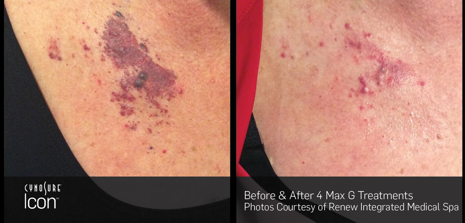 Side-by-side close-ups of a skin bruise before and after treatment, showing fading discoloration.