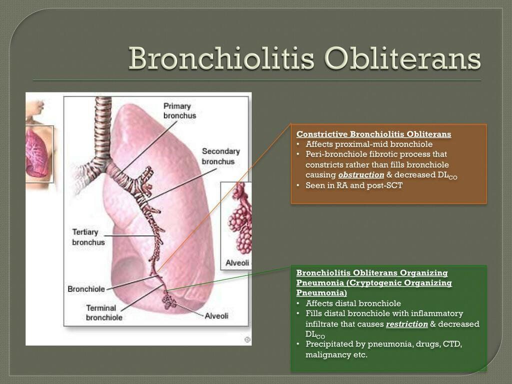 Bronchiolitis Obliterans