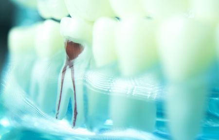 a close up of a tooth with a root canal in it