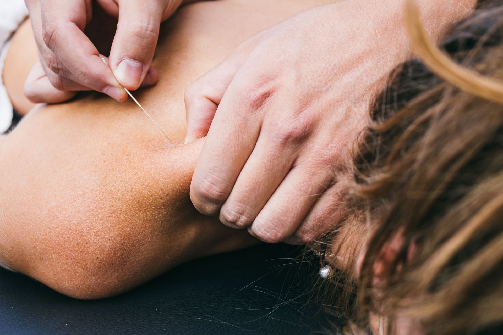 A person is getting acupuncture on their back.