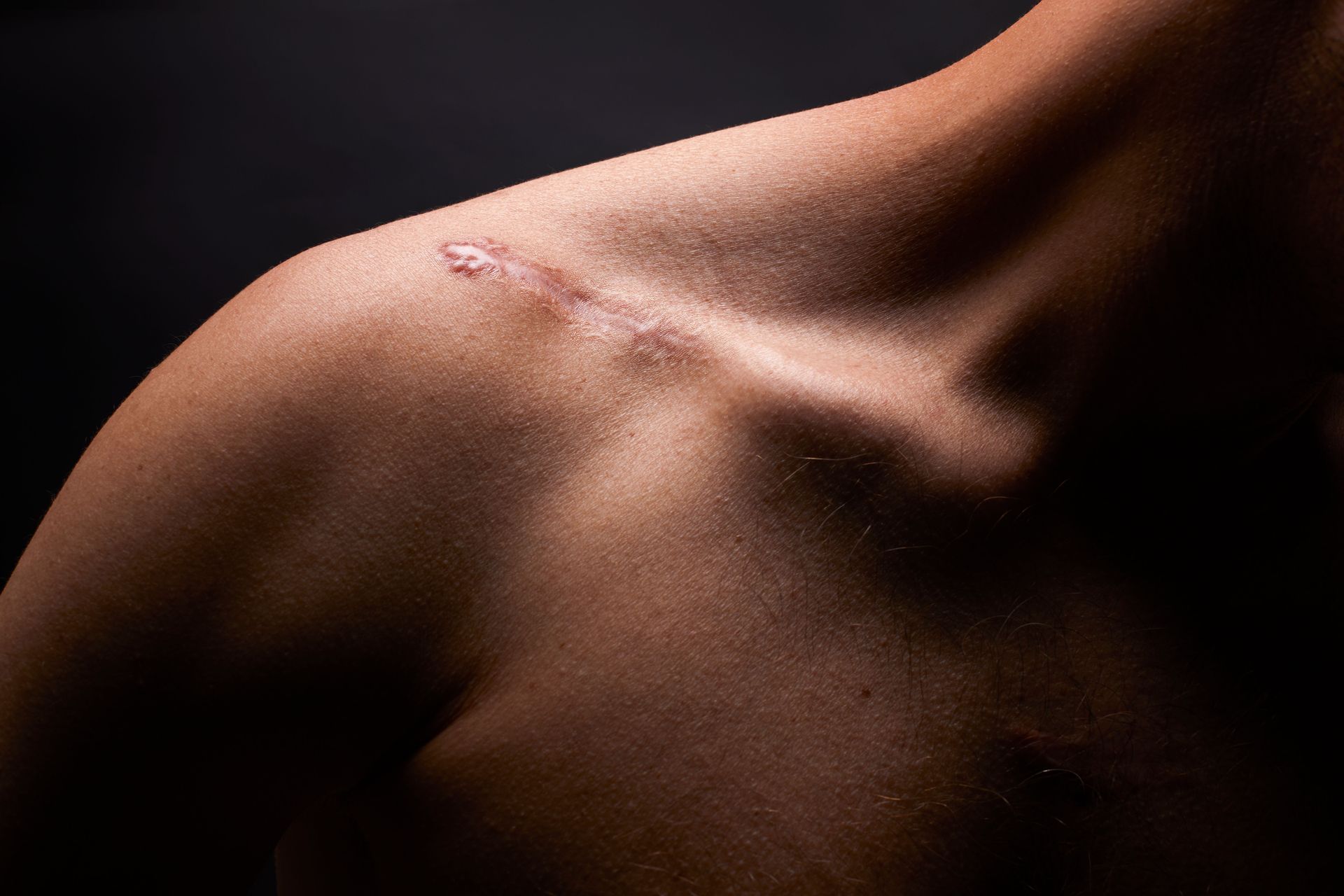 A close up of a person 's shoulder with a scar on it.