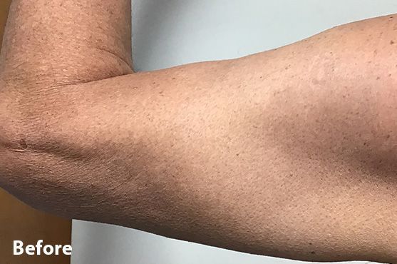 a before and after photo of a woman's arm.