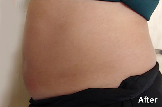 a woman's stomach is shown in a before and after photo.