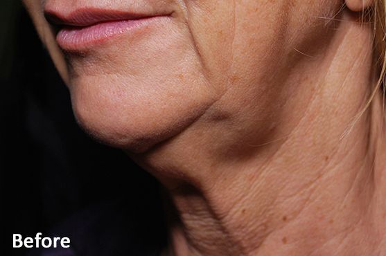 a woman 's neck is shown in a before photo