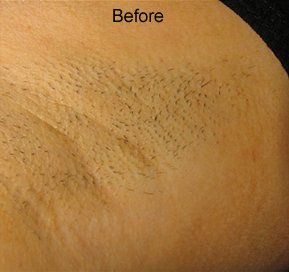 Before hair removal