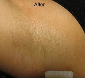 After hair removal