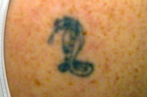 Before tattoo removal
