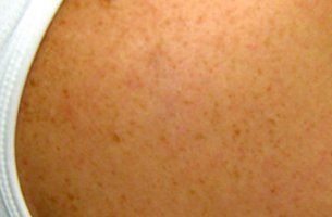 After tattoo removal