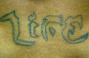 Before tattoo removal