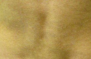 After tattoo removal