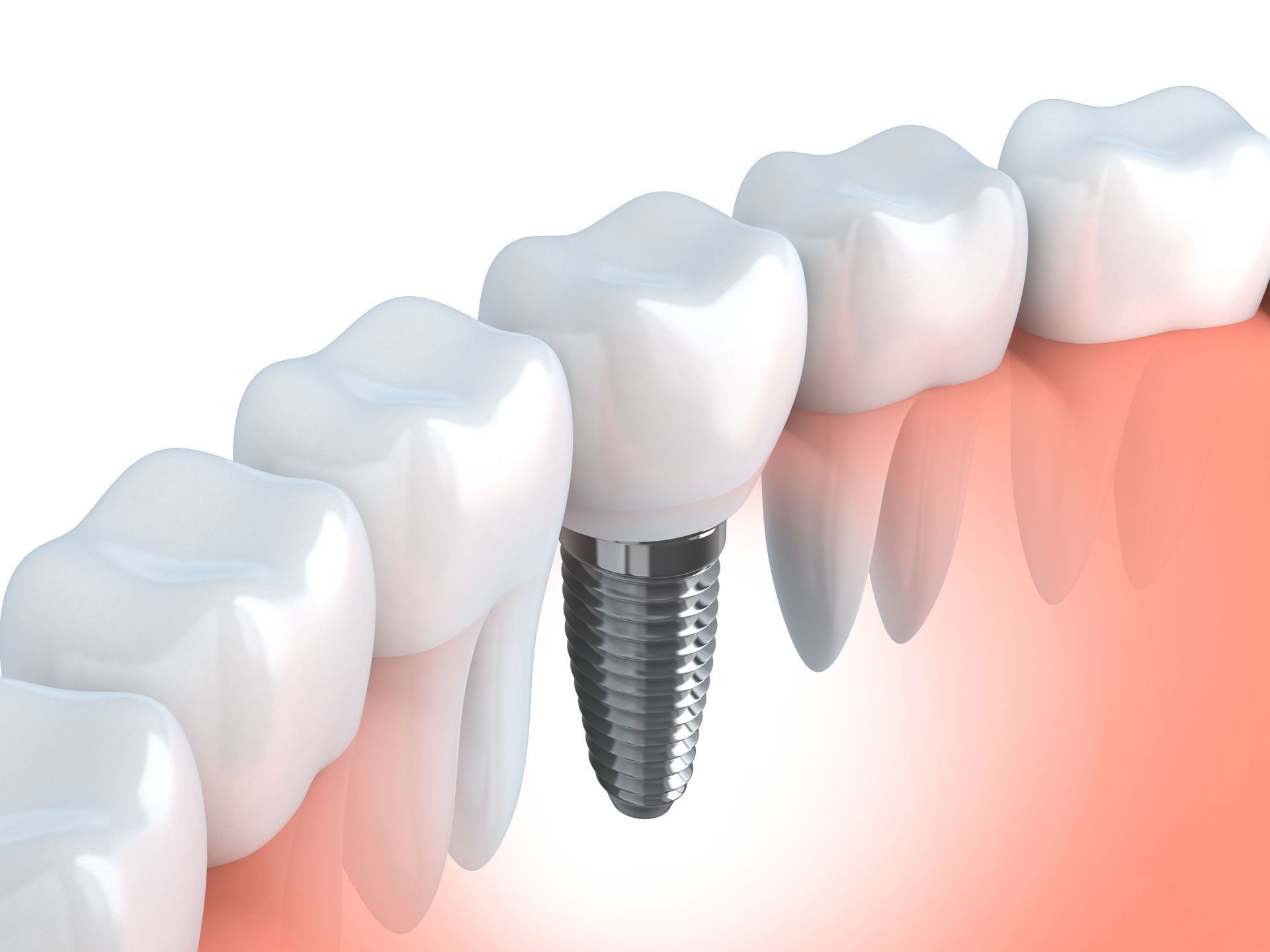 A dental implant replacing a missing tooth, showing the screw-like metal post embedded in the gum with a white crown.