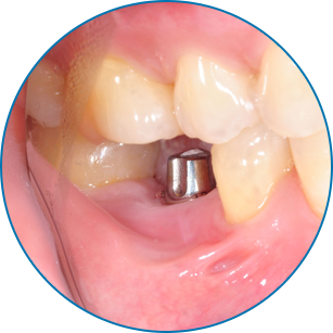 Teeth implantation