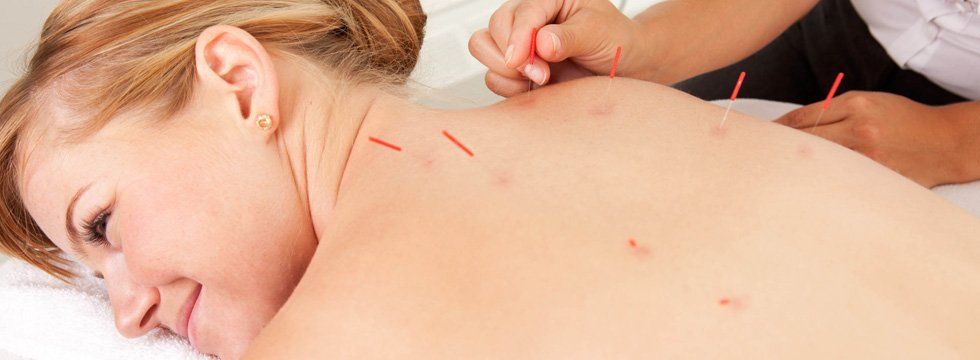 Woman being treated with acupuncture.
