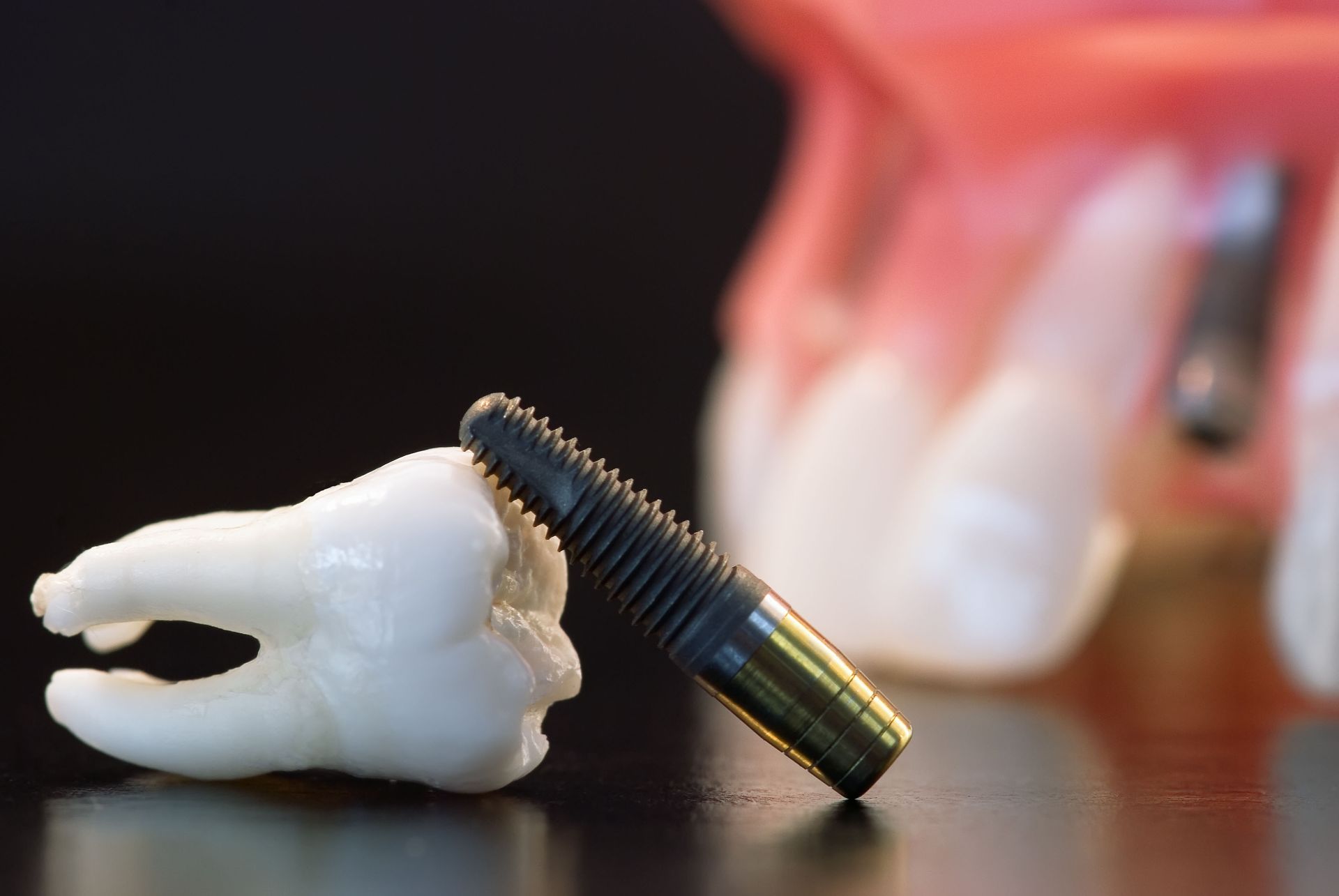 tooth implants