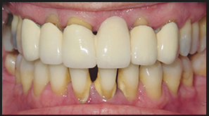 Before dental implants procedure