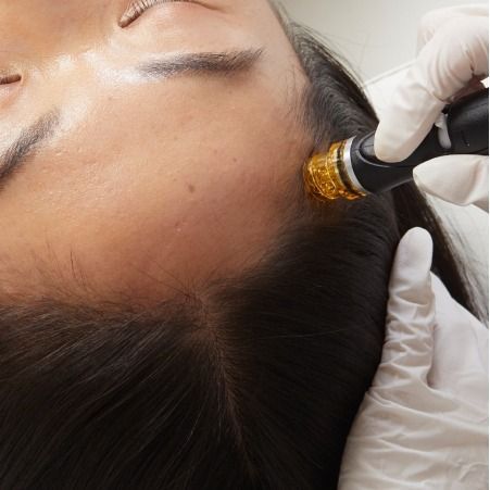 A professional uses a microneedling device with a gold tip on a person's temple for a cosmetic skin treatment.