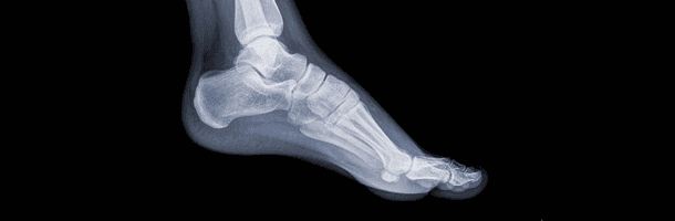 foot x-ray / Achilles Tenodonitis | Willow Street, PA | Kent V. Flinchbaugh DPM, Ltd. | 717-464-2751