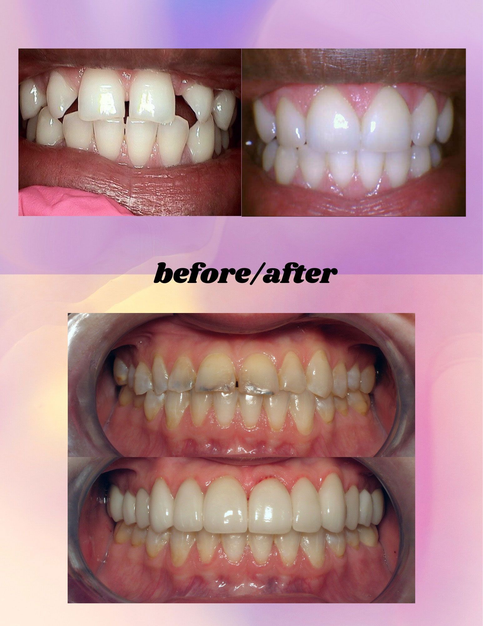 Before and after photos showing two different sets of teeth being corrected and whitened.