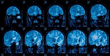Magnetic resonance imaging (MRI) of the brain