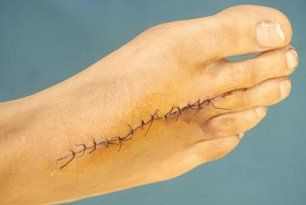 learn More About Foot Surgery Foot Surgery