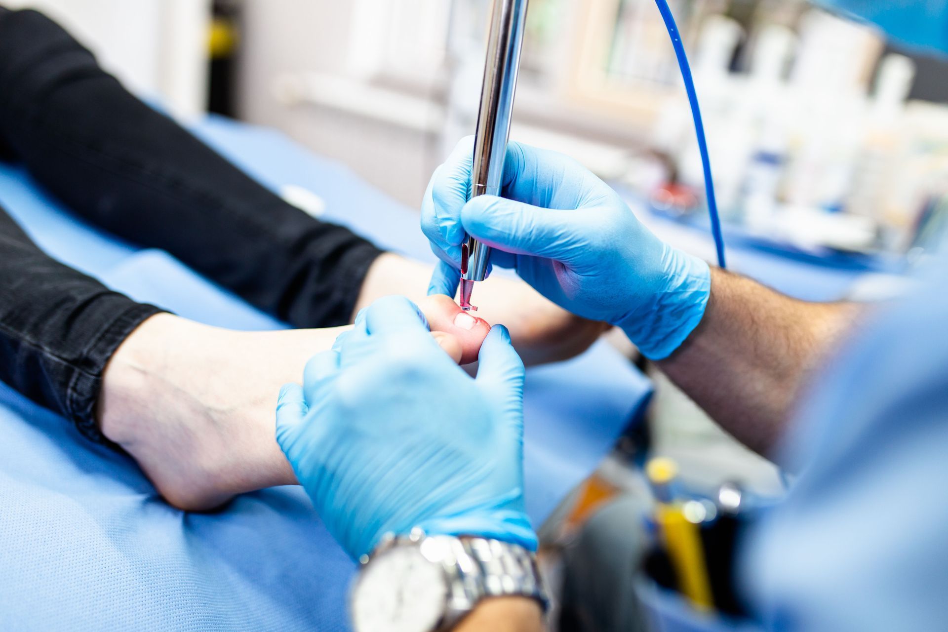 A healthcare professional in blue gloves performs a laser procedure on a person's toe in a clinical setting.