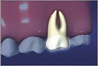 Root Canal process