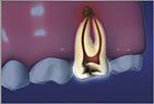 Root Canal process