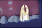 Root Canal process