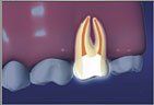 Root Canal process
