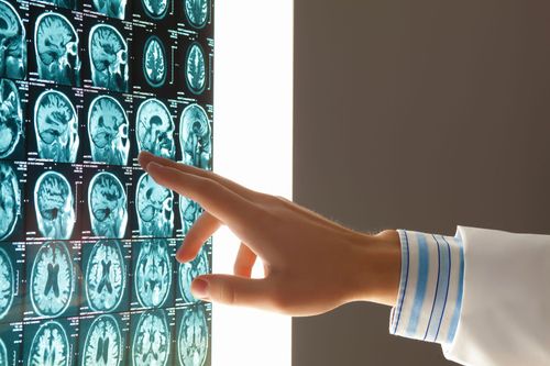 Regina Berkovich MD, PhD Inc. MS Neurology